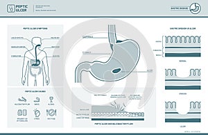 Peptic ulcer and helicobacter pylori infographic