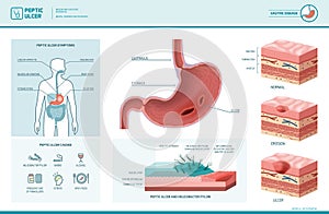 Peptic ulcer and helicobacter pylori infographic photo