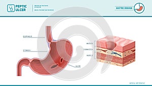 Peptic ulcer medical illustration photo