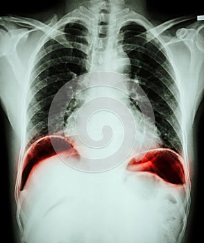 Peptic ulcer perforate