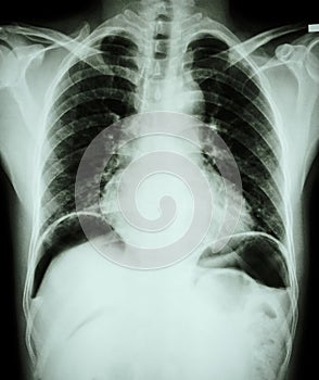 Peptic ulcer perforate . ( film chest x-ray show free air under dome of both diaphragm due to air leak from gastric ulcer or