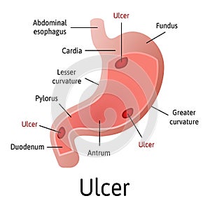 Peptic ulcer of the stomach, microscopic colorful anatomy on a white background. Medical vector illustration with all internal