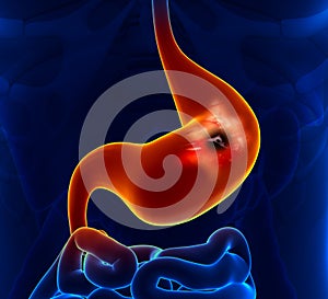 Peptic Ulcer - Stomach problem photo