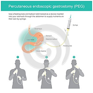 Percutaneous endoscopic gastrostomy PEG