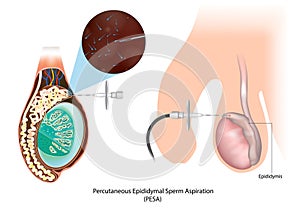 Percutaneous Epididymal Sperm Aspiration PESA. Testicular Biopsy. Epididymis. Azoospermia. Sperm retrieval techniques