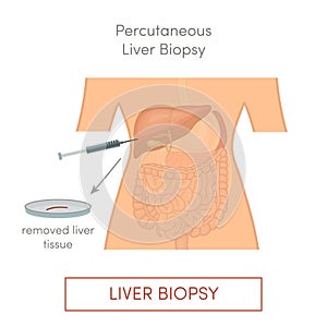 Percutaneous liver biopsy