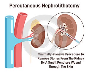 Percutaneous nephrolithotomy. Kidney stone removing surgery. Nephrolithiasis photo