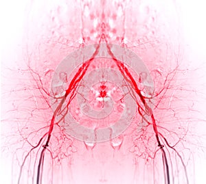 Percutaneous transluminal angioplasty - PTA of the Femoral Artery photo