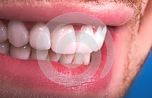 Perfect Close Up White beautiful Veneers Teeth bleaching crowns whitening young lady smiling, Male beard natural man  smile.