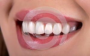 Perfect healthy teeth beautiful wide smile bleaching ceramic crowns whitening of young smiling attractive sexy lips woman. Dental