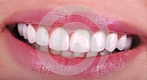 Perfect healthy teeth beautiful wide smile bleaching procedure whitening of young smiling attractive sexy lips woman. Dental