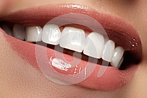 Perfect smile before and after bleaching. Dental care and whiten