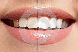Perfetto sorriso Prima un dopo sbiancamento. dentale cura un agente sbiancante denti 