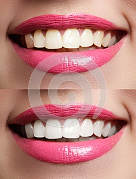 Perfect smile before and after bleaching. Dental care and whitening teeth