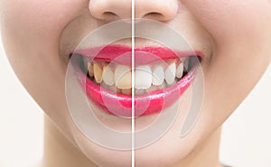 Perfect smile teeth before and after bleaching. whitening teeth photo