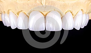 Perfect smile before and after veneers bleach of zircon arch ceramic prothesis Implants crowns. Dental restoration treatment