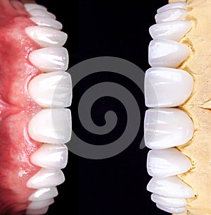 Perfect smile before and after veneers bleach of zircon arch ceramic prothesis Implants crowns. Dental restoration treatment