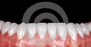 Perfect smile before and after veneers bleach of zircon arch ceramic prothesis Implants crowns. Dental restoration treatment