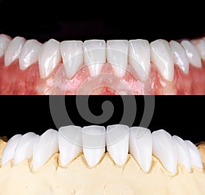 Perfect smile before and after veneers bleach of zircon arch ceramic prothesis Implants crowns. Dental restoration treatment