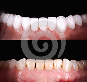 Perfect smile before and after veneers bleach of zircon arch ceramic prothesis Implants crowns. Dental restoration treatment