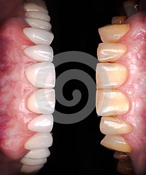 Perfect smile before and after veneers bleach of zircon arch ceramic prothesis Implants crowns. Dental restoration treatment