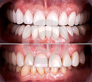 Perfect smile before and after veneers bleach of zircon arch ceramic prothesis Implants crowns. Dental restoration treatment