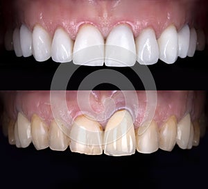Perfect smile before and after veneers bleach of zircon arch ceramic prothesis Implants crowns. Dental restoration treatment clini