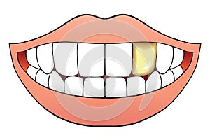 Mouth With Gold Tooth photo