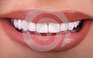 Perfect White beautiful Teeth smile ceramic crowns whitening young lady smiling. zircon implants restoration