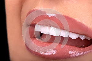 Perfect White beautiful Teeth smile ceramic crowns whitening young lady smiling. zircon implants restoration