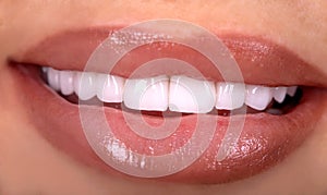 Perfect White beautiful Teeth smile ceramic crowns whitening young lady smiling. zircon implants restoration