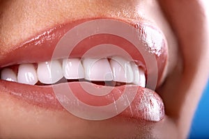 Perfect White beautiful Teeth smile ceramic crowns whitening young lady smiling. zircon implants restoration