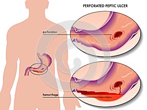 Perforated peptic ulcer photo