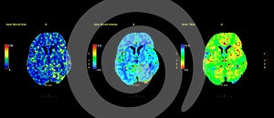 Perfusion CT scan of the brain.