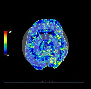 Perfusion CT scan of the brain.