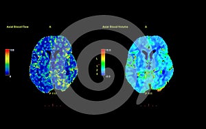 Perfusion CT scan of the brain.