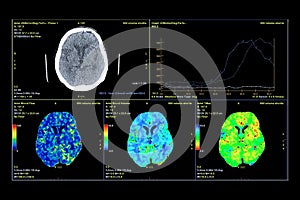 Perfusion CT scan of the brain.