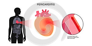 Pericarditis heart disease photo