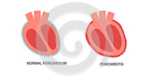 Pericarditis heart disease