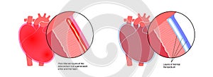 Pericarditis heart disease