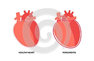 Pericarditis heart disease