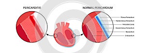 Pericarditis heart disease