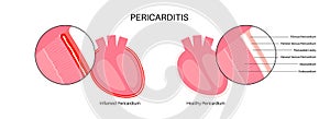 Pericarditis heart disease photo