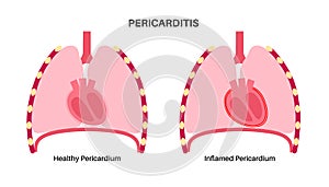 Pericarditis heart disease photo