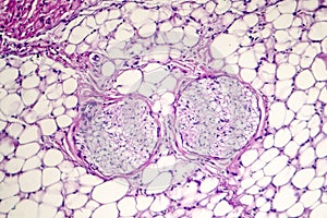 Pericarditis, light micrograph, photo under microscope
