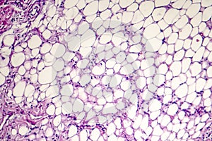 Pericarditis, light micrograph, photo under microscope