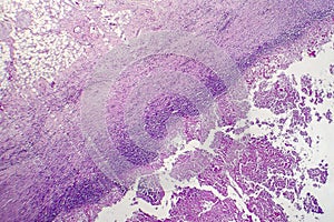 Pericarditis, light micrograph, photo under microscope