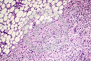 Pericarditis, light micrograph, photo under microscope