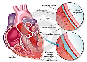 Pericarditis photo