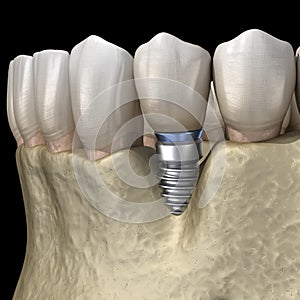 Periimplantitis with visible bone reduction. Medically accurate 3D illustration of dental implants concept